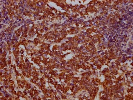 IHC image of CSB-PA002531LA01HU diluted at 1:100 and staining in paraffin-embedded human lung cancer performed on a Leica BondTM system. After dewaxing and hydration, antigen retrieval was mediated by high pressure in a citrate buffer (pH 6.0). Section was blocked with 10% normal goat serum 30min at RT. Then primary antibody (1% BSA) was incubated at 4°C overnight. The primary is detected by a Goat anti-rabbit IgG labeled by HRP and visualized using 0.05% DAB.