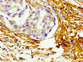Immunohistochemistry of paraffin-embedded human breast cancer using CSB-PA002734LA01HU at dilution of 1:100