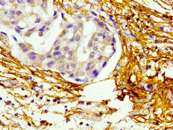 Immunohistochemistry of paraffin-embedded human breast cancer using CSB-PA002734LA01HU at dilution of 1:100