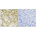 Immunohistochemistry analysis of paraffin-embedded human liver carcinoma tissue, using TFAM antibody.