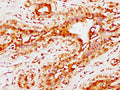 IHC image of CSB-PA004600EA01HU diluted at 1:300 and staining in paraffin-embedded human breast cancer performed on a Leica BondTM system. After dewaxing and hydration, antigen retrieval was mediated by high pressure in a citrate buffer (pH 6.0). Section was blocked with 10% normal goat serum 30min at RT. Then primary antibody (1% BSA) was incubated at 4&deg;C overnight. The primary is detected by a biotinylated secondary antibody and visualized using an HRP conjugated SP system.