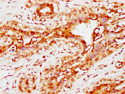 IHC image of CSB-PA004600EA01HU diluted at 1:300 and staining in paraffin-embedded human breast cancer performed on a Leica BondTM system. After dewaxing and hydration, antigen retrieval was mediated by high pressure in a citrate buffer (pH 6.0). Section was blocked with 10% normal goat serum 30min at RT. Then primary antibody (1% BSA) was incubated at 4&deg;C overnight. The primary is detected by a biotinylated secondary antibody and visualized using an HRP conjugated SP system.
