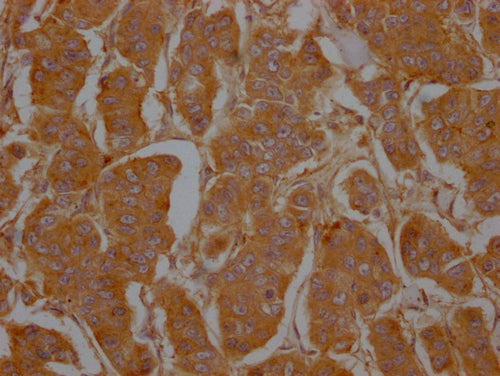IHC image of CSB-PA004969LA01HU diluted at 1:100 and staining in paraffin-embedded human breast cancer performed on a Leica BondTM system. After dewaxing and hydration, antigen retrieval was mediated by high pressure in a citrate buffer (pH 6.0). Section was blocked with 10% normal goat serum 30min at RT. Then primary antibody (1% BSA) was incubated at 4°C overnight. The primary is detected by a Goat anti-rabbit polymer IgG labeled by HRP and visualized using 0.05% DAB.