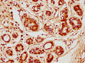 IHC image of CSB-PA005064LA01HU diluted at 1:600 and staining in paraffin-embedded human breast cancer performed on a Leica BondTM system. After dewaxing and hydration, antigen retrieval was mediated by high pressure in a citrate buffer (pH 6.0). Section was blocked with 10% normal goat serum 30min at RT. Then primary antibody (1% BSA) was incubated at 4°C overnight. The primary is detected by a biotinylated secondary antibody and visualized using an HRP conjugated SP system.