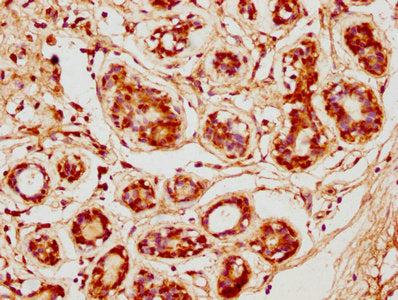 IHC image of CSB-PA005064LA01HU diluted at 1:600 and staining in paraffin-embedded human breast cancer performed on a Leica BondTM system. After dewaxing and hydration, antigen retrieval was mediated by high pressure in a citrate buffer (pH 6.0). Section was blocked with 10% normal goat serum 30min at RT. Then primary antibody (1% BSA) was incubated at 4°C overnight. The primary is detected by a biotinylated secondary antibody and visualized using an HRP conjugated SP system.
