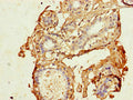 Immunohistochemistry of paraffin-embedded human breast cancer using CSB-PA005075LA01HU at dilution of 1:100