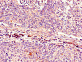 Immunohistochemistry of paraffin-embedded human cervical cancer using CSB-PA005089LA01HU at dilution of 1:100