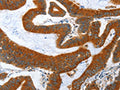 The image on the left is immunohistochemistry of paraffin-embedded Human colon cancer tissue using CSB-PA005512(ANAPC10 Antibody) at dilution 1/40, on the right is treated with fusion protein. (Original magnification: ×200)