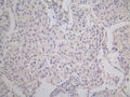 IHC image of CSB-PA005746LA01HU diluted at 1:150 and staining in paraffin-embedded human lung cancer performed on a Leica BondTM system. After dewaxing and hydration, antigen retrieval was mediated by high pressure in a citrate buffer (pH 6.0). Section was blocked with 10% normal goat serum 30min at RT. Then primary antibody (1% BSA) was incubated at 4°C overnight. The primary is detected by a Goat anti-rabbit polymer IgG labeled by HRP and visualized using 0.05% DAB.