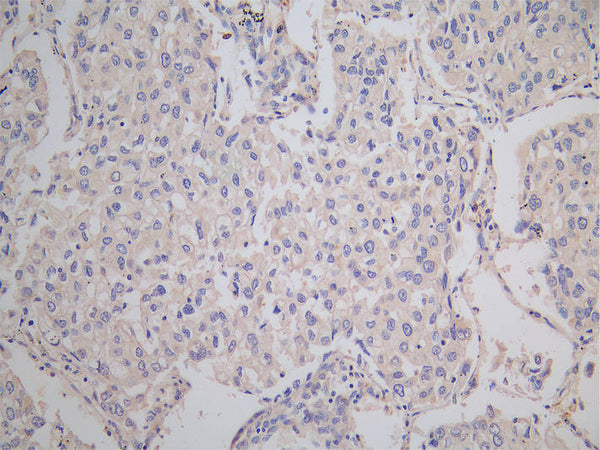 IHC image of CSB-PA005746LA01HU diluted at 1:150 and staining in paraffin-embedded human lung cancer performed on a Leica BondTM system. After dewaxing and hydration, antigen retrieval was mediated by high pressure in a citrate buffer (pH 6.0). Section was blocked with 10% normal goat serum 30min at RT. Then primary antibody (1% BSA) was incubated at 4°C overnight. The primary is detected by a Goat anti-rabbit polymer IgG labeled by HRP and visualized using 0.05% DAB.