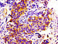 Immunohistochemistry of paraffin-embedded human bladder cancer using CSB-PA005752LA01HU at dilution of 1:100