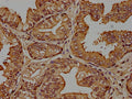 IHC image of CSB-PA005963OA01HU diluted at 1:100 and staining in paraffin-embedded human prostate cancer performed on a Leica BondTM system. After dewaxing and hydration, antigen retrieval was mediated by high pressure in a citrate buffer (pH 6.0). Section was blocked with 10% normal goat serum 30min at RT. Then primary antibody (1% BSA) was incubated at 4°C overnight. The primary is detected by a biotinylated secondary antibody and visualized using an HRP conjugated SP system.