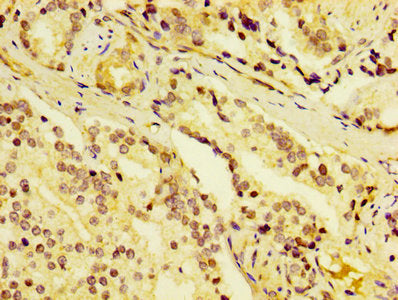 IHC image of CSB-PA006537DA01HU diluted at 1:400 and staining in paraffin-embedded human prostate cancer performed on a Leica BondTM system. After dewaxing and hydration, antigen retrieval was mediated by high pressure in a citrate buffer (pH 6.0). Section was blocked with 10% normal goat serum 30min at RT. Then primary antibody (1% BSA) was incubated at 4&deg;C overnight. The primary is detected by a biotinylated secondary antibody and visualized using an HRP conjugated SP system.
