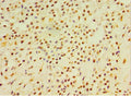 Immunohistochemistry of paraffin-embedded human breast cancer using CSB-PA006705ESR1HU at dilution of 1:100