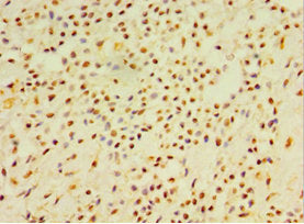 Immunohistochemistry of paraffin-embedded human breast cancer using CSB-PA006705ESR1HU at dilution of 1:100