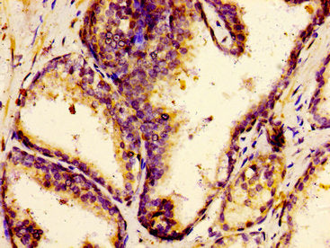 Immunohistochemistry of paraffin-embedded human prostate cancer using CSB-PA007918LA01HU at dilution of 1:100