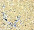 Immunohistochemistry of paraffin-embedded human liver cancer using CSB-PA007930HA01HU at dilution of 1:100