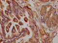 IHC image of CSB-PA008452LA01HU diluted at 1:200 and staining in paraffin-embedded human prostate tissue performed on a Leica BondTM system. After dewaxing and hydration, antigen retrieval was mediated by high pressure in a citrate buffer (pH 6.0). Section was blocked with 10% normal goat serum 30min at RT. Then primary antibody (1% BSA) was incubated at 4°C overnight. The primary is detected by a Goat anti-rabbit polymer IgG labeled by HRP and visualized using 0.05% DAB.