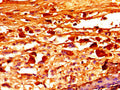 Immunohistochemistry of paraffin-embedded human melanoma using CSB-PA008456LA01HU at dilution of 1:100