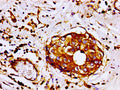 Immunohistochemistry of paraffin-embedded human breast cancer using CSB-PA008724LA01HU at dilution of 1:100