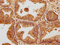 IHC image of CSB-PA009018PA01HU diluted at 1:100 and staining in paraffin-embedded human prostate cancer performed on a Leica BondTM system. After dewaxing and hydration, antigen retrieval was mediated by high pressure in a citrate buffer (pH 6.0). Section was blocked with 10% normal goat serum 30min at RT. Then primary antibody (1% BSA) was incubated at 4°C overnight. The primary is detected by a biotinylated secondary antibody and visualized using an HRP conjugated SP system.