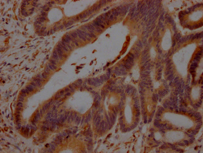 IHC image of CSB-PA009344LA01HU diluted at 1:100 and staining in paraffin-embedded human colon cancer performed on a Leica BondTM system. After dewaxing and hydration, antigen retrieval was mediated by high pressure in a citrate buffer (pH 6.0). Section was blocked with 10% normal goat serum 30min at RT. Then primary antibody (1% BSA) was incubated at 4°C overnight. The primary is detected by a Goat anti-rabbit polymer IgG labeled by HRP and visualized using 0.05% DAB.