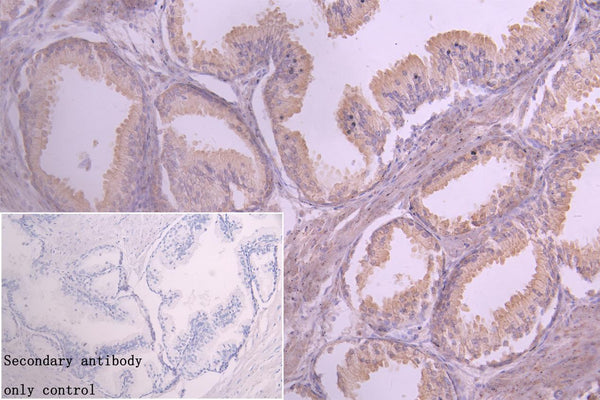 IHC image of CSB-PA822219LA01HU diluted at 1:20 and staining in paraffin-embedded human prostate cancer performed on a Leica BondTM system. After dewaxing and hydration, antigen retrieval was mediated by high pressure in a citrate buffer (pH 6.0). Section was blocked with 10% normal goat serum 30min at RT. Then primary antibody (1% BSA) was incubated at 4°C overnight. The primary is detected by a Goat anti-rabbit polymer IgG labeled by HRP and visualized using 0.05% DAB.