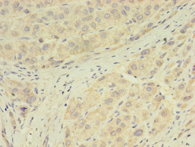 Immunohistochemistry of paraffin-embedded human liver cancer using CSB-PA009872LA01HU at dilution of 1:100
