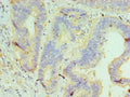 Immunohistochemistry of paraffin-embedded human colon cancer using CSB-PA010064ESR1HU at dilution of 1:100