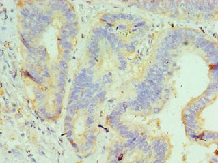 Immunohistochemistry of paraffin-embedded human colon cancer using CSB-PA010064ESR1HU at dilution of 1:100