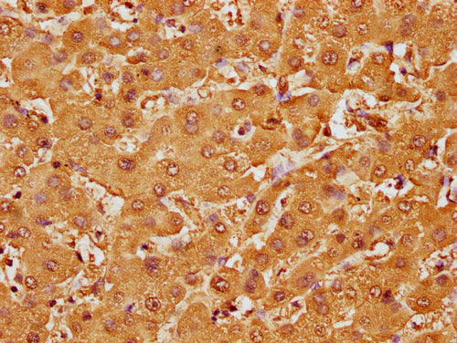 IHC image of CSB-PA010087OA107nme1HU diluted at 1:10 and staining in paraffin-embedded human liver tissue performed on a Leica BondTM system. After dewaxing and hydration, antigen retrieval was mediated by high pressure in a citrate buffer (pH 6.0). Section was blocked with 10% normal goat serum 30min at RT. Then primary antibody (1% BSA) was incubated at 4°C overnight. The primary is detected by a biotinylated secondary antibody and visualized using an HRP conjugated SP system.