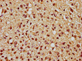 IHC image of CSB-PA010376OA21nme1HU diluted at 1:10 and staining in paraffin-embedded human glioma cancer performed on a Leica BondTM system. After dewaxing and hydration, antigen retrieval was mediated by high pressure in a citrate buffer (pH 6.0). Section was blocked with 10% normal goat serum 30min at RT. Then primary antibody (1% BSA) was incubated at 4°C overnight. The primary is detected by a biotinylated secondary antibody and visualized using an HRP conjugated SP system.