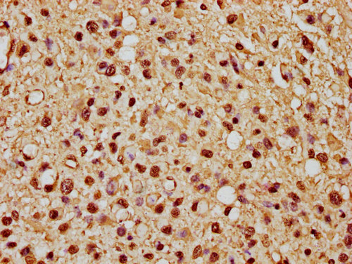IHC image of CSB-PA010376OA21nme1HU diluted at 1:10 and staining in paraffin-embedded human glioma cancer performed on a Leica BondTM system. After dewaxing and hydration, antigen retrieval was mediated by high pressure in a citrate buffer (pH 6.0). Section was blocked with 10% normal goat serum 30min at RT. Then primary antibody (1% BSA) was incubated at 4°C overnight. The primary is detected by a biotinylated secondary antibody and visualized using an HRP conjugated SP system.