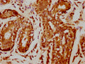 IHC image of CSB-PA010378PA109nforHU diluted at 1:20 and staining in paraffin-embedded human breast cancer performed on a Leica BondTM system. After dewaxing and hydration, antigen retrieval was mediated by high pressure in a citrate buffer (pH 6.0). Section was blocked with 10% normal goat serum 30min at RT. Then primary antibody (1% BSA) was incubated at 4°C overnight. The primary is detected by a biotinylated secondary antibody and visualized using an HRP conjugated SP system.
