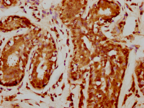 IHC image of CSB-PA010378PA109nforHU diluted at 1:20 and staining in paraffin-embedded human breast cancer performed on a Leica BondTM system. After dewaxing and hydration, antigen retrieval was mediated by high pressure in a citrate buffer (pH 6.0). Section was blocked with 10% normal goat serum 30min at RT. Then primary antibody (1% BSA) was incubated at 4°C overnight. The primary is detected by a biotinylated secondary antibody and visualized using an HRP conjugated SP system.