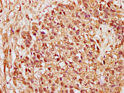 IHC image of CSB-PA010378PA89nacHU diluted at 1:15 and staining in paraffin-embedded human ovarian cancer performed on a Leica BondTM system. After dewaxing and hydration, antigen retrieval was mediated by high pressure in a citrate buffer (pH 6.0). Section was blocked with 10% normal goat serum 30min at RT. Then primary antibody (1% BSA) was incubated at 4°C overnight. The primary is detected by a biotinylated secondary antibody and visualized using an HRP conjugated SP system.