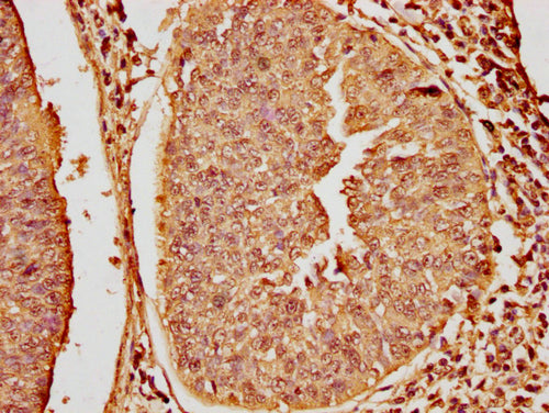 IHC image of CSB-PA010379OA16nme1HU diluted at 1:20 and staining in paraffin-embedded human cervical cancer performed on a Leica BondTM system. After dewaxing and hydration, antigen retrieval was mediated by high pressure in a citrate buffer (pH 6.0). Section was blocked with 10% normal goat serum 30min at RT. Then primary antibody (1% BSA) was incubated at 4°C overnight. The primary is detected by a biotinylated secondary antibody and visualized using an HRP conjugated SP system.