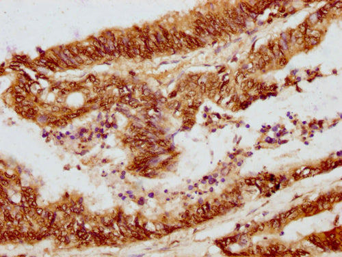 IHC image of CSB-PA010380OA01nphHU diluted at 1:10 and staining in paraffin-embedded human colon cancer performed on a Leica BondTM system. After dewaxing and hydration, antigen retrieval was mediated by high pressure in a citrate buffer (pH 6.0). Section was blocked with 10% normal goat serum 30min at RT. Then primary antibody (1% BSA) was incubated at 4°C overnight. The primary is detected by a biotinylated secondary antibody and visualized using an HRP conjugated SP system.