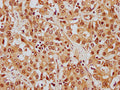 IHC image of CSB-PA010380OA26nphHU diluted at 1:8 and staining in paraffin-embedded human liver cancer performed on a Leica BondTM system. After dewaxing and hydration, antigen retrieval was mediated by high pressure in a citrate buffer (pH 6.0). Section was blocked with 10% normal goat serum 30min at RT. Then primary antibody (1% BSA) was incubated at 4°C overnight. The primary is detected by a biotinylated secondary antibody and visualized using an HRP conjugated SP system.