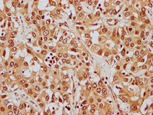 IHC image of CSB-PA010380OA26nphHU diluted at 1:8 and staining in paraffin-embedded human liver cancer performed on a Leica BondTM system. After dewaxing and hydration, antigen retrieval was mediated by high pressure in a citrate buffer (pH 6.0). Section was blocked with 10% normal goat serum 30min at RT. Then primary antibody (1% BSA) was incubated at 4°C overnight. The primary is detected by a biotinylated secondary antibody and visualized using an HRP conjugated SP system.