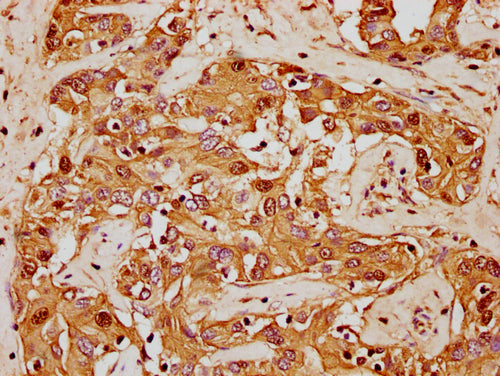 IHC image of CSB-PA010380OA62nforHU diluted at 1:20 and staining in paraffin-embedded human liver cancer performed on a Leica BondTM system. After dewaxing and hydration, antigen retrieval was mediated by high pressure in a citrate buffer (pH 6.0). Section was blocked with 10% normal goat serum 30min at RT. Then primary antibody (1% BSA) was incubated at 4°C overnight. The primary is detected by a biotinylated secondary antibody and visualized using an HRP conjugated SP system.