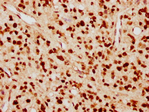 IHC image of CSB-PA010389PA09nacHU diluted at 1:10 and staining in paraffin-embedded human glioma cancer performed on a Leica BondTM system. After dewaxing and hydration, antigen retrieval was mediated by high pressure in a citrate buffer (pH 6.0). Section was blocked with 10% normal goat serum 30min at RT. Then primary antibody (1% BSA) was incubated at 4°C overnight. The primary is detected by a biotinylated secondary antibody and visualized using an HRP conjugated SP system.