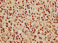 IHC image of CSB-PA010389PA74nhibHU diluted at 1:5 and staining in paraffin-embedded human glioma cancer performed on a Leica BondTM system. After dewaxing and hydration, antigen retrieval was mediated by high pressure in a citrate buffer (pH 6.0). Section was blocked with 10% normal goat serum 30min at RT. Then primary antibody (1% BSA) was incubated at 4°C overnight. The primary is detected by a biotinylated secondary antibody and visualized using an HRP conjugated SP system.