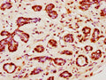 IHC image of CSB-PA010403PA120nsucHU diluted at 1:10 and staining in paraffin-embedded human breast cancer performed on a Leica BondTM system. After dewaxing and hydration, antigen retrieval was mediated by high pressure in a citrate buffer (pH 6.0). Section was blocked with 10% normal goat serum 30min at RT. Then primary antibody (1% BSA) was incubated at 4°C overnight. The primary is detected by a biotinylated secondary antibody and visualized using an HRP conjugated SP system.