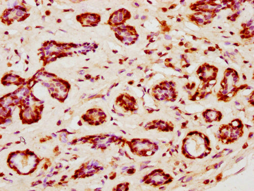 IHC image of CSB-PA010403PA120nsucHU diluted at 1:10 and staining in paraffin-embedded human breast cancer performed on a Leica BondTM system. After dewaxing and hydration, antigen retrieval was mediated by high pressure in a citrate buffer (pH 6.0). Section was blocked with 10% normal goat serum 30min at RT. Then primary antibody (1% BSA) was incubated at 4°C overnight. The primary is detected by a biotinylated secondary antibody and visualized using an HRP conjugated SP system.