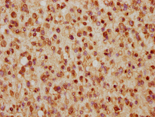 IHC image of CSB-PA010403PA57nhibHU diluted at 1:5 and staining in paraffin-embedded human glioma cancer performed on a Leica BondTM system. After dewaxing and hydration, antigen retrieval was mediated by high pressure in a citrate buffer (pH 6.0). Section was blocked with 10% normal goat serum 30min at RT. Then primary antibody (1% BSA) was incubated at 4°C overnight. The primary is detected by a biotinylated secondary antibody and visualized using an HRP conjugated SP system.