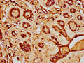 IHC image of CSB-PA010429PA20nacHU diluted at 1:20 and staining in paraffin-embedded human breast cancer performed on a Leica BondTM system. After dewaxing and hydration, antigen retrieval was mediated by high pressure in a citrate buffer (pH 6.0). Section was blocked with 10% normal goat serum 30min at RT. Then primary antibody (1% BSA) was incubated at 4°C overnight. The primary is detected by a biotinylated secondary antibody and visualized using an HRP conjugated SP system.