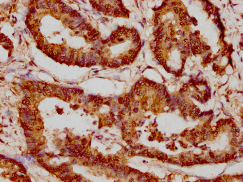 IHC image of CSB-PA010429PA77nacHU diluted at 1:20 and staining in paraffin-embedded human colon cancer performed on a Leica BondTM system. After dewaxing and hydration, antigen retrieval was mediated by high pressure in a citrate buffer (pH 6.0). Section was blocked with 10% normal goat serum 30min at RT. Then primary antibody (1% BSA) was incubated at 4°C overnight. The primary is detected by a biotinylated secondary antibody and visualized using an HRP conjugated SP system.