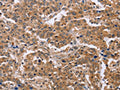 The image on the left is immunohistochemistry of paraffin-embedded Human liver cancer tissue using CSB-PA010637(EPDR1 Antibody) at dilution 1/40, on the right is treated with fusion protein. (Original magnification: ×200)