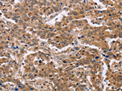 The image on the left is immunohistochemistry of paraffin-embedded Human liver cancer tissue using CSB-PA010637(EPDR1 Antibody) at dilution 1/40, on the right is treated with fusion protein. (Original magnification: ×200)